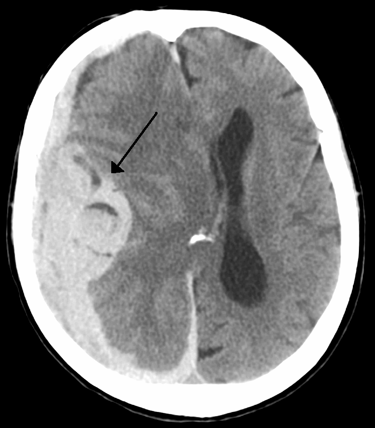 Intra Parenchymal Bleed with Edema.jpg